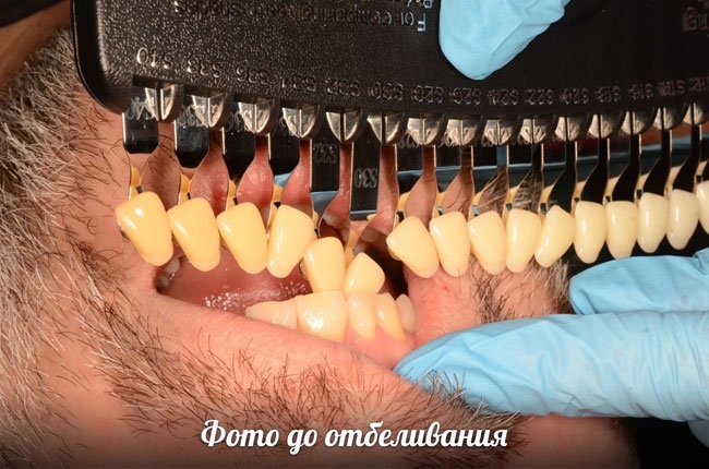 Отбеливание зубов с помощью аппарата Amazing White
