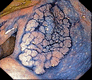 эндоскопия: латерально распространяющаяся опухоль купола слепой кишки (после окраски)